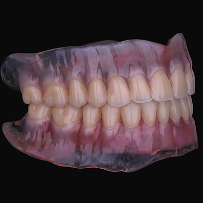 Traditional dentures with detailed characterization for a more natural and aesthetic look overall.